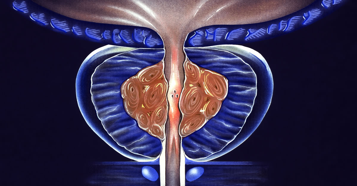 Greenlight Laser BPH Treatment