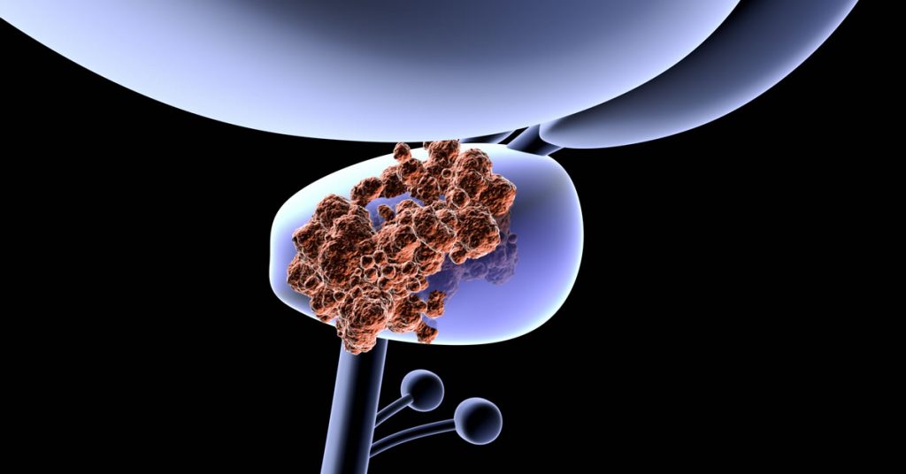 The Gleason Score for Prostate Cancer Prostate Prognosis